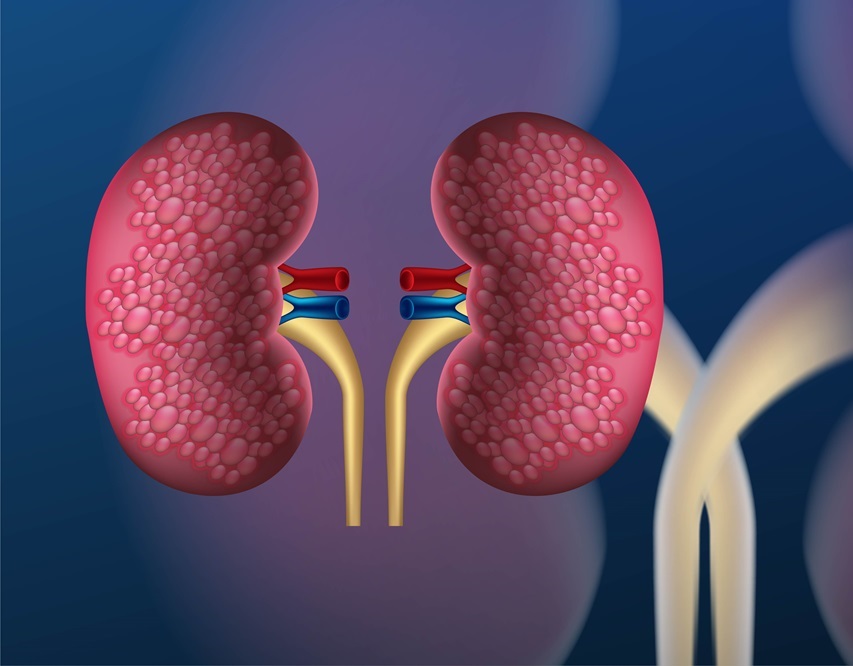 kidney disease, Human anatomy care. kidney cancer. realistic ve